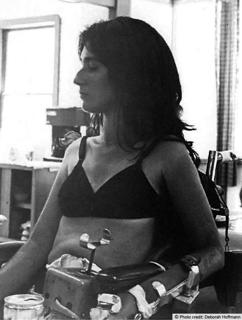 A young woman with dark seated in a wheel chair with her left arm in a metal brace. Photo credit: Deborah Hoffman